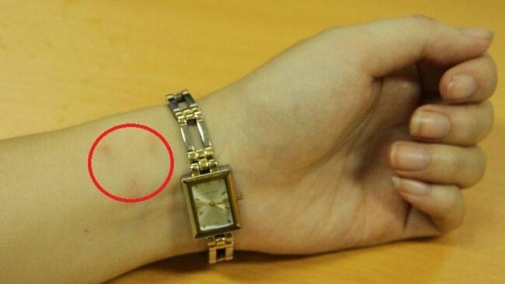 CÁCH XỬ LÝ KHI ĐEO ĐỒNG HỒ BỊ NGỨA TAY: NGUYÊN NHÂN & GIẢI PHÁP TỐI ƯU