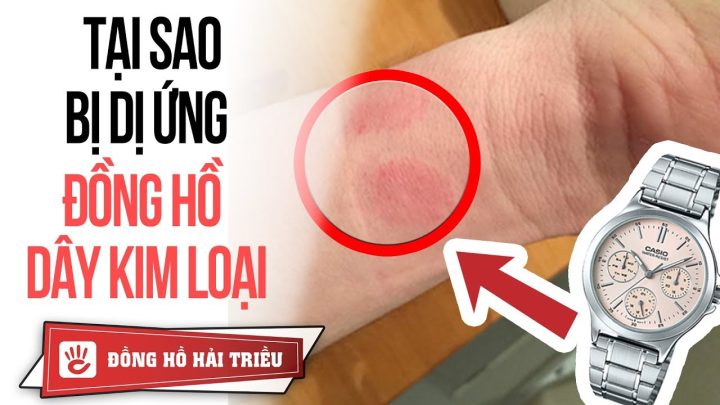 Đeo Đồng Hồ Bị Nổi Hạt: Nguyên Nhân, Cách Xử Lý và Bí Quyết Phòng Ngừa Hiệu Quả